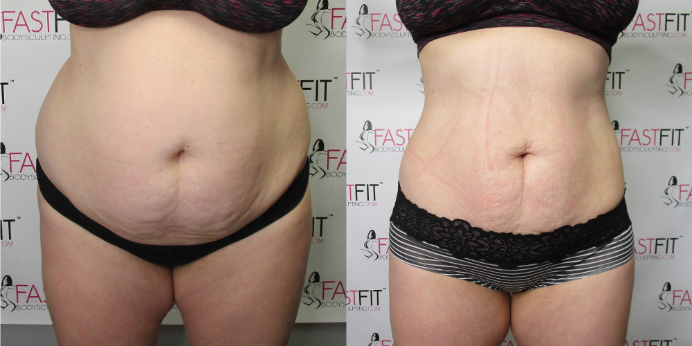 Results - Fast Fit Body Sculpting