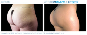 Emsculpt Neo Emtone PIC Ba card female buttock 008 ENUS100