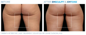 Emsculpt Neo Emtone PIC Ba card female inner thigh 005 ENUS1