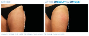 Emsculpt Neo Emtone PIC Ba card female outer thigh 006 ENUS1