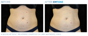 Emtone PIC Ba card female abdomen 008 ENUS100