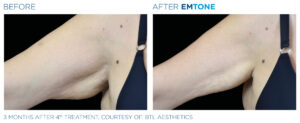 Emtone PIC Ba card female arms 005 ENUS100