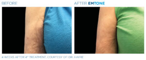 Emtone PIC Ba card female arms 013 ENUS100
