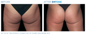 Emtone PIC Ba card female buttock 001 ENUS100