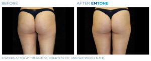 Emtone PIC Ba card female buttock 009 ENUS100