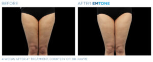 Emtone PIC Ba card female thighs 012 EN100.1